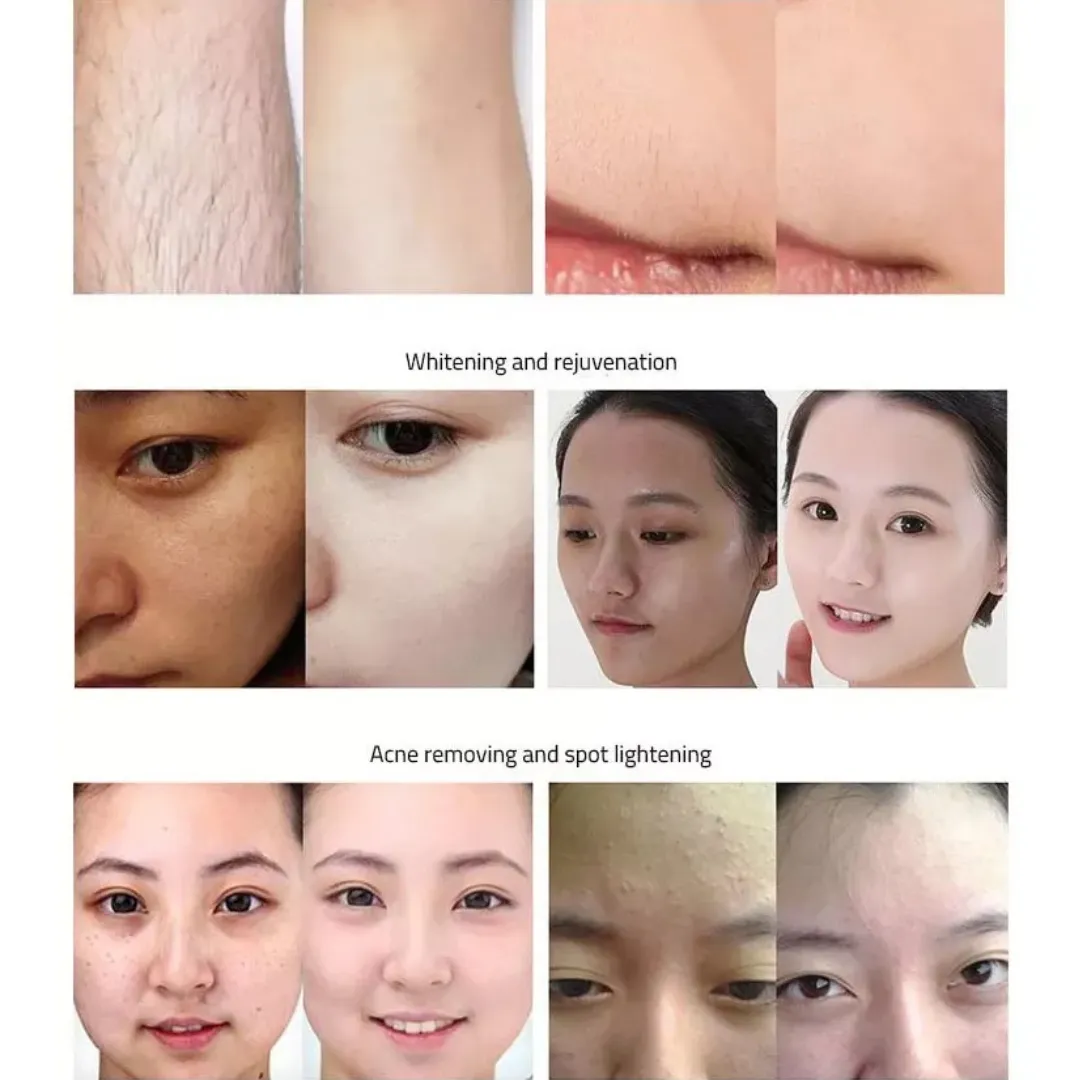 Luminous Skin OPT Laser